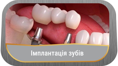 implantatsia-zubiv